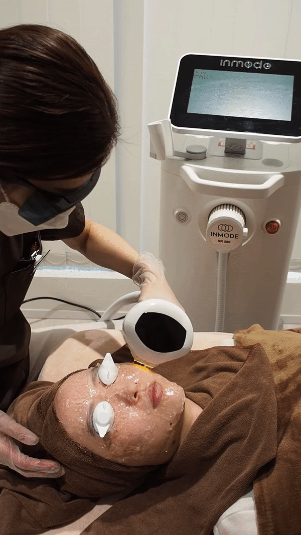 光治療（IPL）のイメージ画像